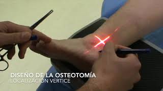 01. Osteotomía percutánea calcánea