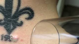 Laser tattoo removal on the back of the neck,  black tattoo on a female’s neck