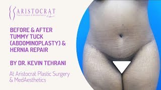 Before & After Tummy Tuck Abdominoplasty Long Island, New York by Dr. Kevin Tehrani