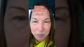 Food Allergy Reaction! #shorts #foodallergy #foodallergyawareness #food