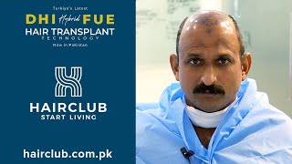 Hybrid FUE Hair Transplant with DHI Technology by Hair Club Associates.