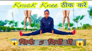 Knock Knee Problem Solution | Knock Knee Kaise Thik Kre | Viral video