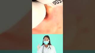 Dr.Nattacha, blackheads ears, acne,extraction.