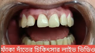 ফাঁকা দাঁতের চিকিৎসা কিভাবে করা হয়। Teeth Gap treatment in Bangladesh।  Tech Dental