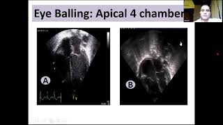 How to assess cardiac contraction by eye balling..