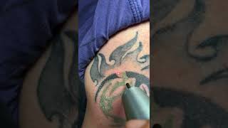 Laser tattoo lightening for coverup