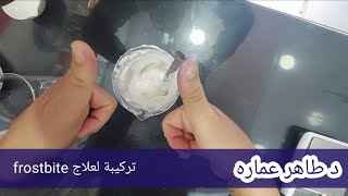 تركيبه لعلاج frostbite