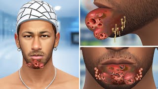 ASMR Removes Worms, Pustules, Maggots on Chin & Blackheads | Deep Cleaning Animation