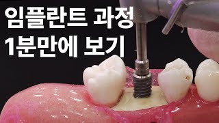 임플란트 수술 과정 1분만에 보기 + 통증 줄이는 팁