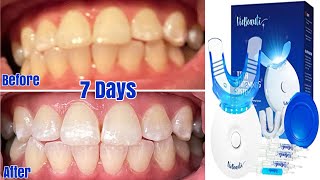 VieBeauti Teeth Whitening System Unboxing /Review 7 Days Later