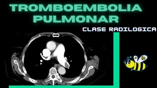 Tromboembolia pulmonar "clase radiológica"