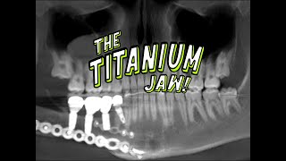 The Titanium Jaw Channel Trailer