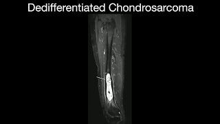 Dedifferentiated Chondrosarcoma 1