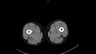 Компьютерная томография сосудов нижних конечностей с внутривенным болюсным контрастированием