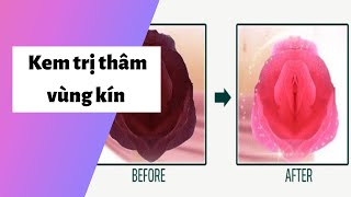 Review 5 kem trị thâm vùng kín tốt, hiệu quả, an toàn nhất | Kèm Giá Bán