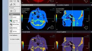 Fusion Superimposition Secondary only Merged & Subtraction