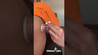 La terapia con ventosas o cupping en la fisioterapia