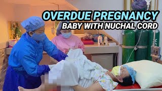 DELIVERY WITH NUCHAL CORD I OVERDUE PREGNANCY: 40 WEEKS AND 3 DAYS G3P3 I PULUPOT NA PUSOD