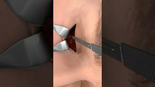 Eye Fracture Surgery. Video credit: MED-animationMedical (youtube)