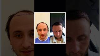 Hair transplant result in Bellus Clinic #hairtransplantjourney