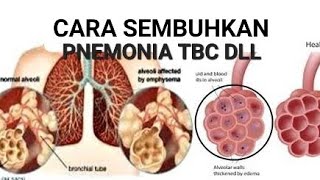 Cara sembuhkan penyakit paru-paru : pnemonia, asma,batuk,TBC @agentiensbatam8481