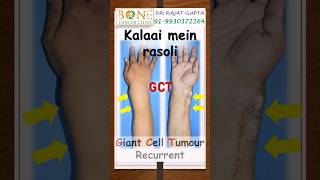 🔥Recurrent #bonetumour #GCT wrist cured successfully-Dr Rajat Gupta @bonecancerclinic