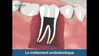 Le traitement endodontique - Esthetic Hair Smile