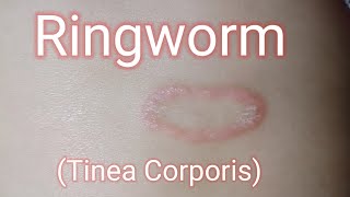 Ringworm Skin infection || Diagnosis and Treatment