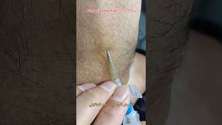 طريقة تشكيل كانيولا Cannula insertion