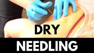 How Dry Needling  Works to Help  My Shoulder