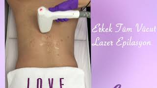 Erkeklerde Buz Lazer Epilasyon Uygulamamız / Love Beauty Center