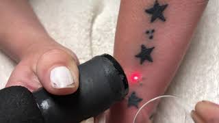 Laser tattoo removal on Asian female’s forearm