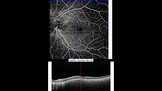 Zeiss Plex Elite 9000 12mmx12mm 100kHz Angiography SweptSource OCT Scan of Left Eye