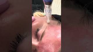 SkinPen Video