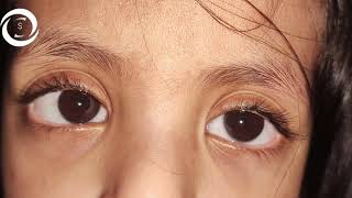 Ophthalmic Signs Adnexa