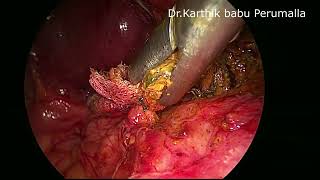 Laparoscopic CBD exploration with removal of migrated stent fragments and large CBD calculi