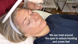 Fractional resurfacing treatment using eTwo Sublative