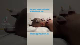 Wet Cupping Hijama & Leech Therapy 🌿