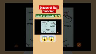 stages of nail clubbing #shortsvideo #shortsviralvideo #shorts