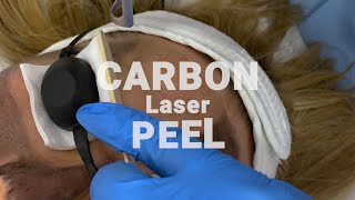 Ultimate Skin Renewal: Carbon Laser Peel in Stunning 4K | See Every Detail