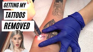 Getting My Tattoos Removed: Watch My Appointment