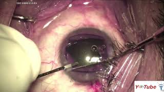 Phacoemulsification using a "made in India" Pupil expander device: Dr Ankit Agrawal