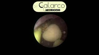 DR CALARCO - Calcolosi ureterale multipla laser - Dr. Calarco