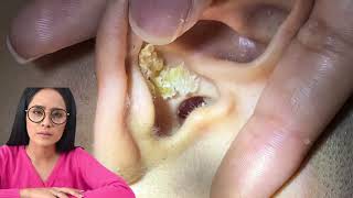 Dr.Natacha earwax removal earclining satisfying.