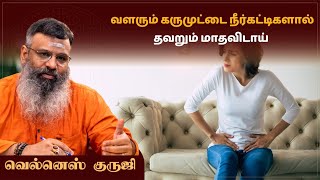 வளரும் கருமுட்டை நீர்க்கட்டிகளால் தவறும் மாதவிடாய்