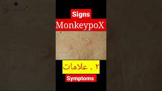 MonkeypoX. Signs and Symptoms #shorts #dr #monkeypox