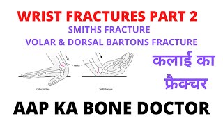 SMITH'S FRACTURE AND VOLAR AND DORSAL BARTON'S FRACTURES - EPISODE - 4