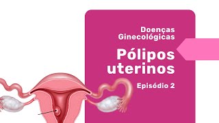 Mulheres, Atenção! Pólipos Uterinos Podem Afetar sua Saúde - Dr. Pedro Doria Explica