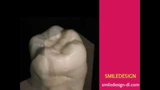 SMILEDESIGN　shikeichoukoku　歯型彫刻