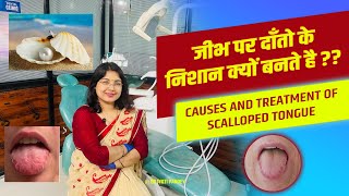 जीभ पर दाँतो के निशान क्यों बनते है ?? Causes and Treatment of Scalloped tongue..